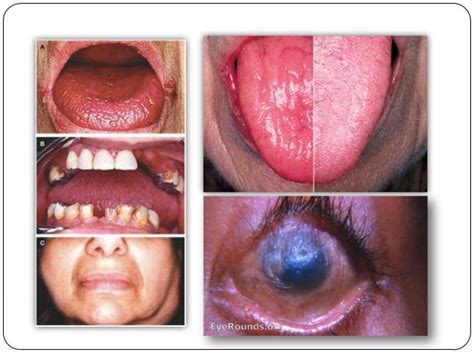 sjogren's syndrome tear test filter|sjogren's syndrome biopsy.